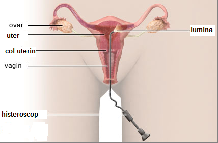 suspiciunea de polip endometrial)